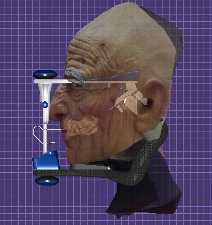 Face model and virtual articulator shown in exocad
